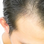 Hair transplant surgery can slow down hair loss and FOR MEN Salon and Spa can help clients find a specialist.