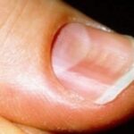 Nail Care performed by a professional can spot irregularities in men's nails.