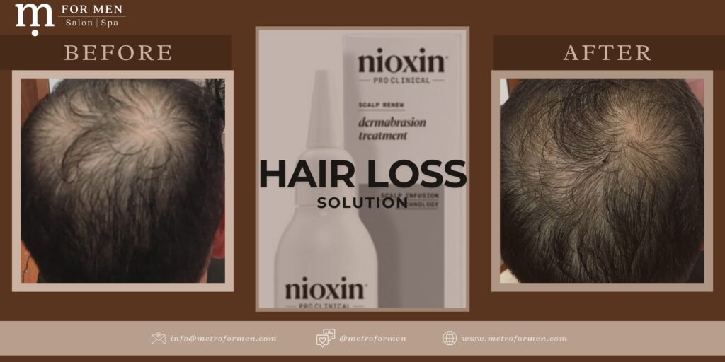 Hair Loss Treatment that works! Check out Nioxin Scalp Renew offered at FOR MEN Salon and Spa in Lake Forest today.