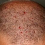 Scalp acne is when the hair follicles become clogged with oil and dead skin cells, leading to pimples or cysts on the scalp.