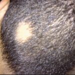 Scalp alopecia areata can be noticed by hairstylists and can recommend you see a medical professional for treatment.