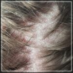 Scalp contact dermatitis is an inflammatory skin reaction caused by direct contact with an irritant or allergen.