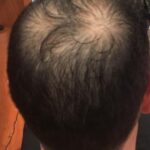 Minoxidil and Rogaine are effective treatments for this condition. Many master men's hairstylists are educated on this topic. 