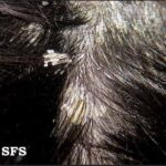 Pityriasis amiantacea is a scalp condition characterized by thick, silvery scales that cling to the hair shafts, often in a "sheath-like" manner.