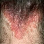 Pityriasis rosea is a skin condition that typically presents as a large, scaly, pink patch followed by smaller patches on the body.