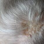 Scalp seborrheic keratosis is a benign skin growth that appears as a brown, black, or light tan lesion on the scalp.