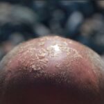 Scalp sunburn occurs when the scalp is overexposed to ultraviolet (UV) rays. Overexposure to the sun leads to redness, pain, and peeling.