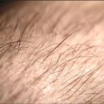 Telogen effluvium is a form of temporary hair loss that occurs when a large number of hair follicles enter the telogen (resting) phase simultaneously.